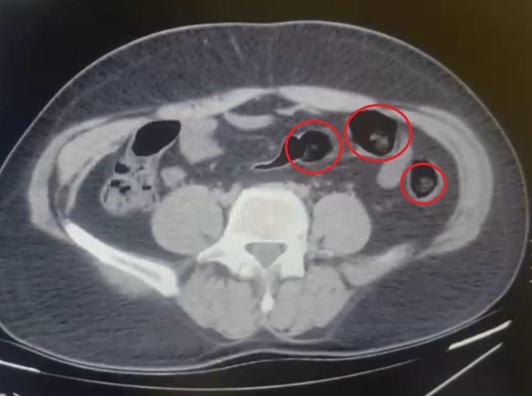 Yolcu otobüsünde şoke eden operasyon! Mide ve bağırsaklarından yarım kilo uyuşturucu çıktı